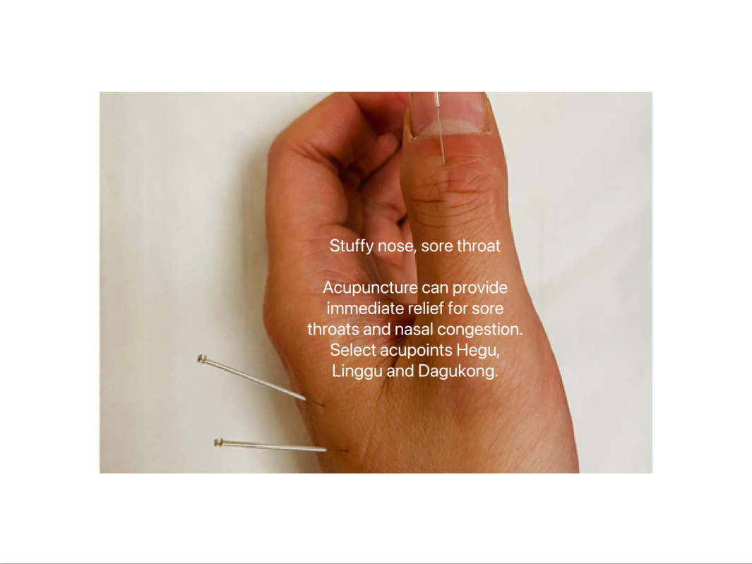 Acupuncture for Colds and Flu (Sneezing, nasal congestion, runny nose