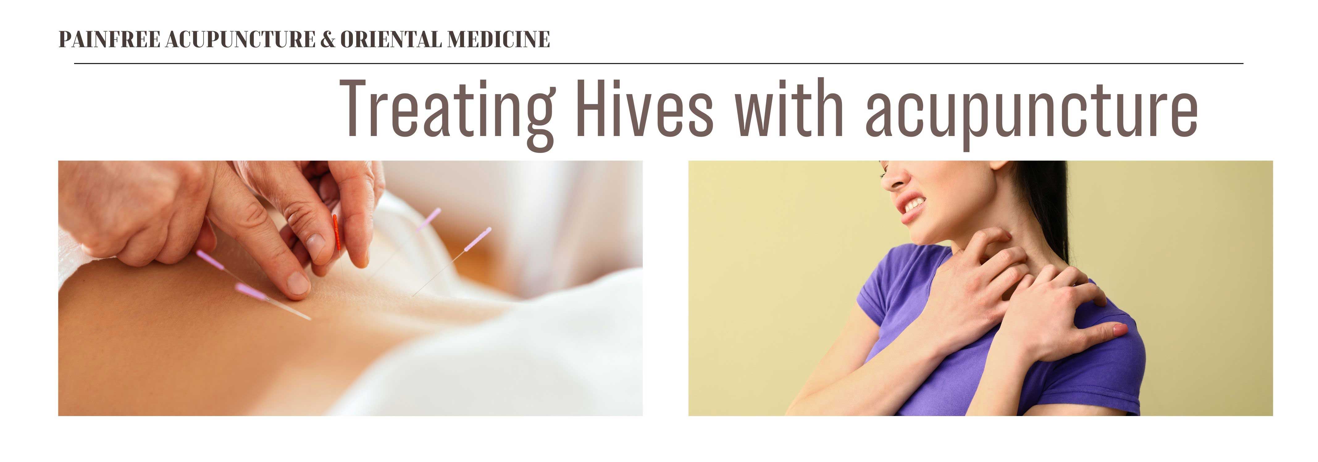 acupuncture for hives