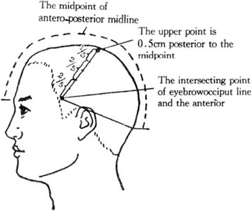 Acupuncture